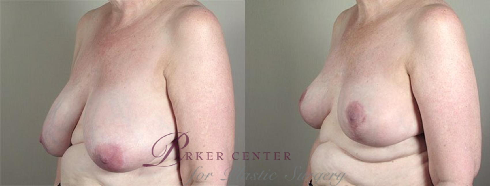 Breast Lift Case 538 Before & After View #2 | Paramus, NJ | Parker Center for Plastic Surgery