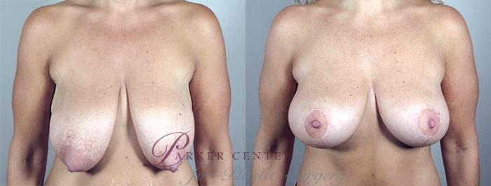 Breast Lift Case 548 Before & After View #1 | Paramus, NJ | Parker Center for Plastic Surgery