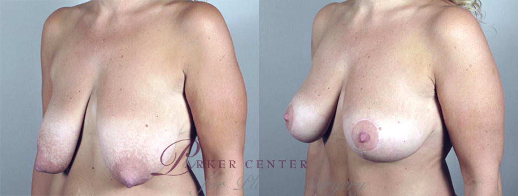 Breast Lift Case 548 Before & After View #2 | Paramus, New Jersey | Parker Center for Plastic Surgery