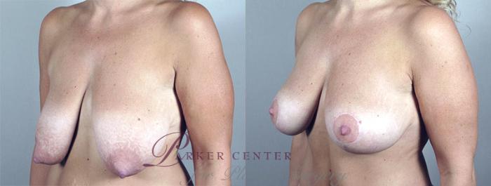 Breast Lift Case 548 Before & After View #2 | Paramus, NJ | Parker Center for Plastic Surgery