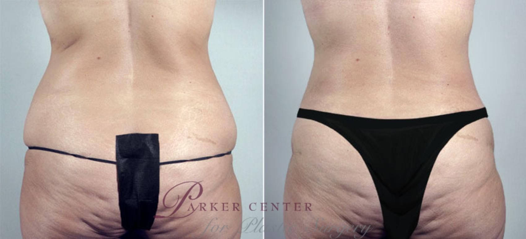 Breast Lift Case 548 Before & After View #5 | Paramus, NJ | Parker Center for Plastic Surgery