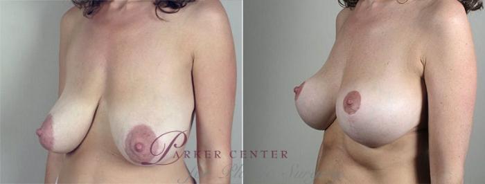 Breast Lift Case 549 Before & After View #1 | Paramus, NJ | Parker Center for Plastic Surgery
