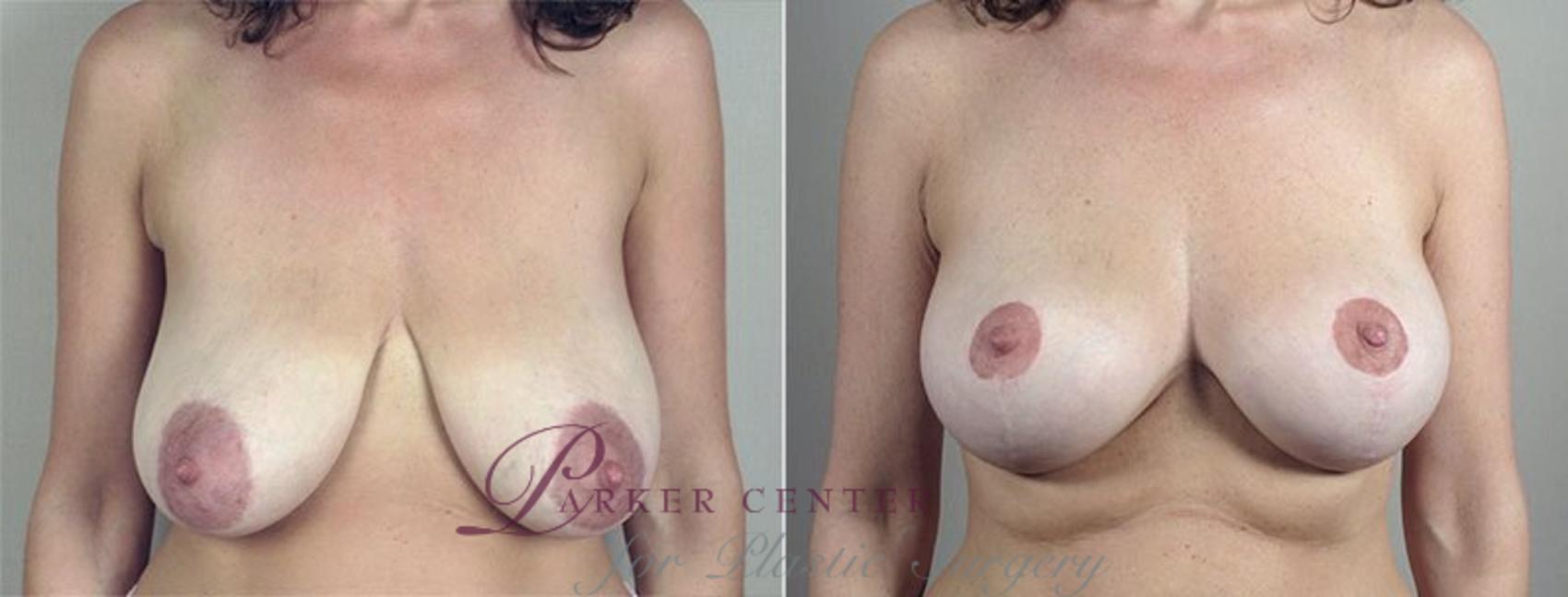 Breast Lift Case 549 Before & After View #2 | Paramus, NJ | Parker Center for Plastic Surgery