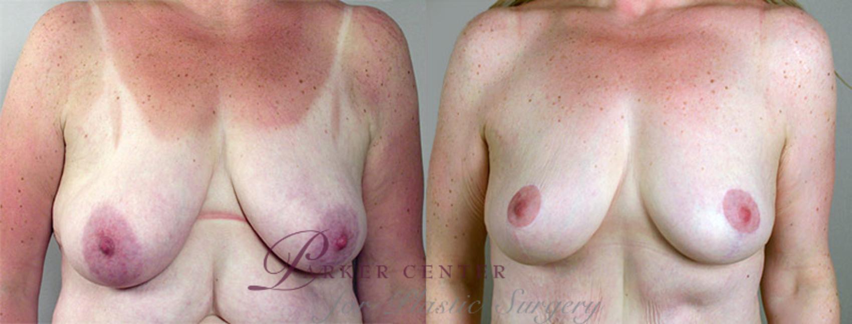 Breast Lift Case 550 Before & After View #1 | Paramus, NJ | Parker Center for Plastic Surgery