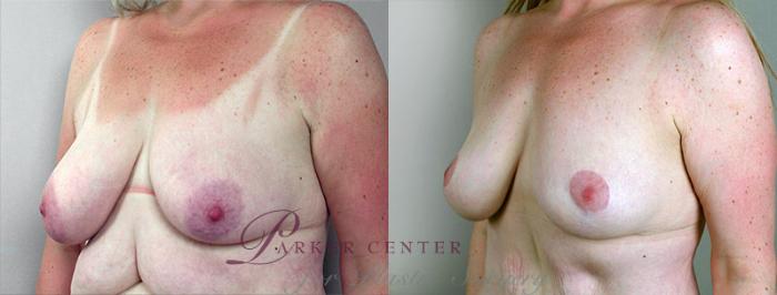 Breast Lift Case 550 Before & After View #2 | Paramus, NJ | Parker Center for Plastic Surgery