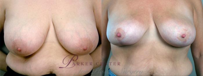 Breast Lift Case 551 Before & After View #1 | Paramus, NJ | Parker Center for Plastic Surgery