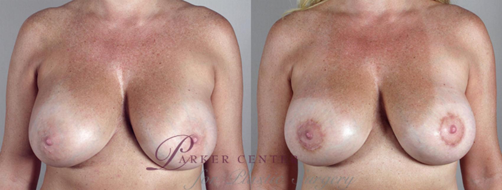 Breast Implant Revision Case 552 Before & After View #1 | Paramus, NJ | Parker Center for Plastic Surgery