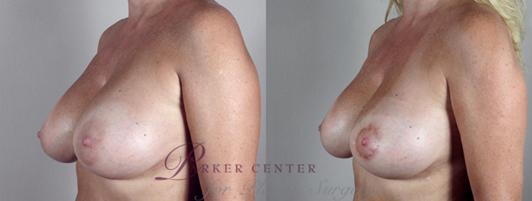 Breast Implant Revision Case 552 Before & After View #2 | Paramus, NJ | Parker Center for Plastic Surgery