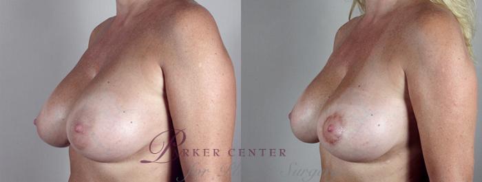Breast Lift Case 552 Before & After View #2 | Paramus, NJ | Parker Center for Plastic Surgery