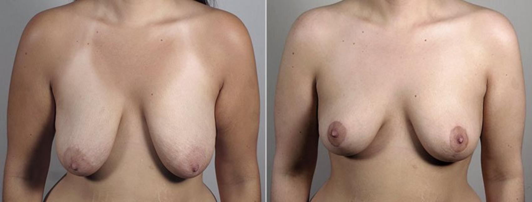 Breast Lift Case 554 Before & After View #1 | Paramus, New Jersey | Parker Center for Plastic Surgery