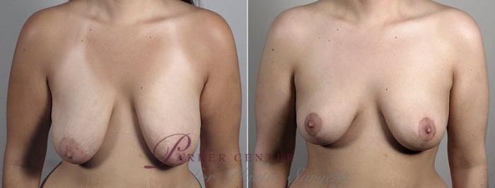 Breast Lift Case 554 Before & After View #1 | Paramus, NJ | Parker Center for Plastic Surgery