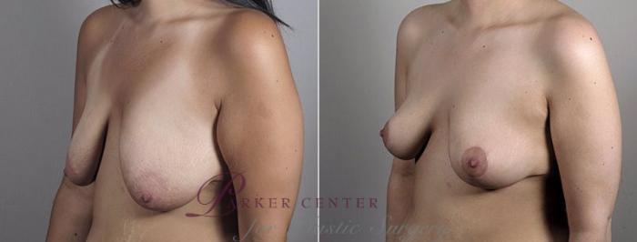 Breast Lift Case 554 Before & After View #2 | Paramus, NJ | Parker Center for Plastic Surgery