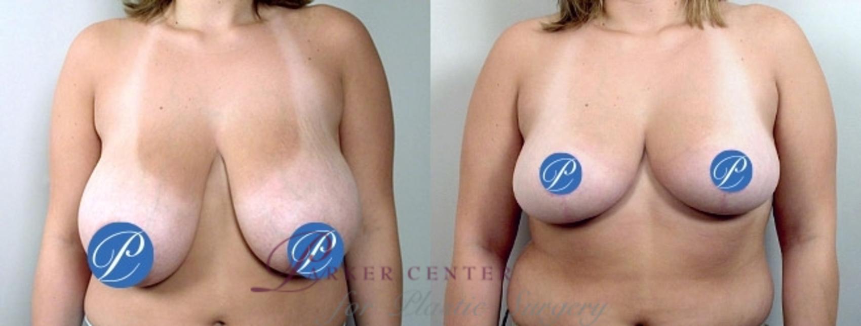 Breast Reduction Case 899 Before & After View #4 | Paramus, NJ | Parker Center for Plastic Surgery