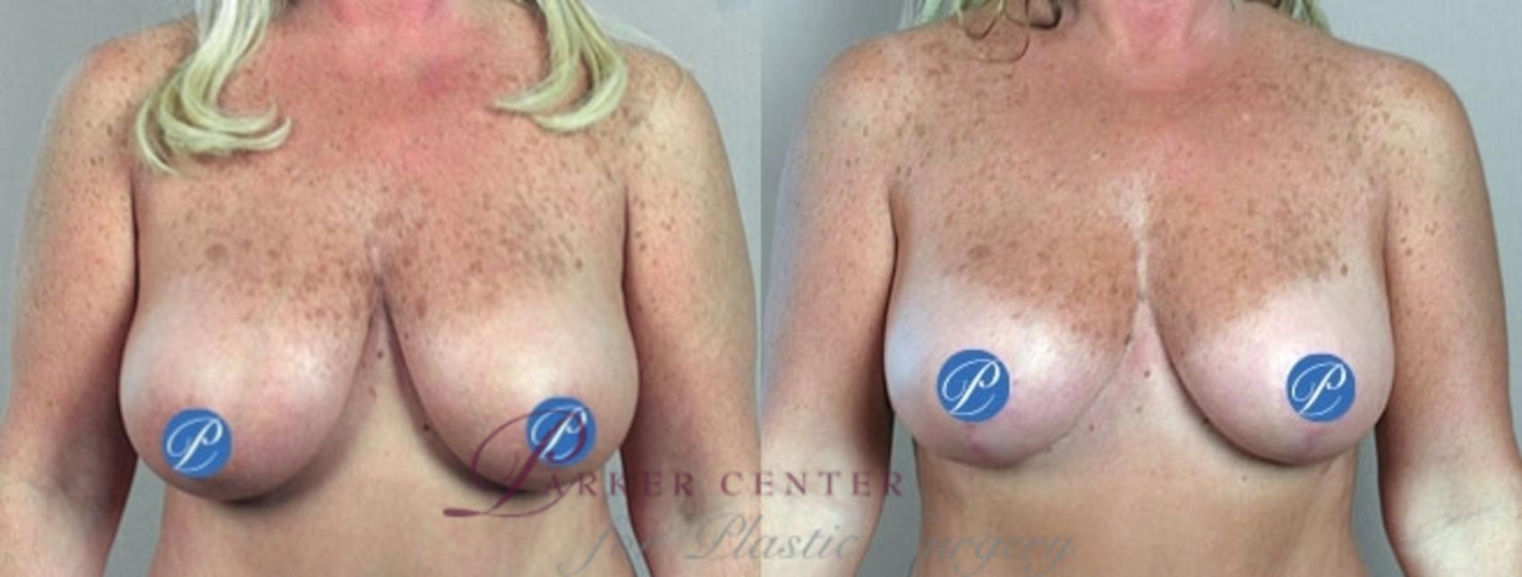 Breast Lift Case 900 Before & After View #4 | Paramus, NJ | Parker Center for Plastic Surgery