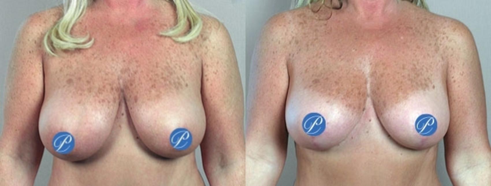 Breast Lift Case 900 Before & After View #4 | Paramus, New Jersey | Parker Center for Plastic Surgery