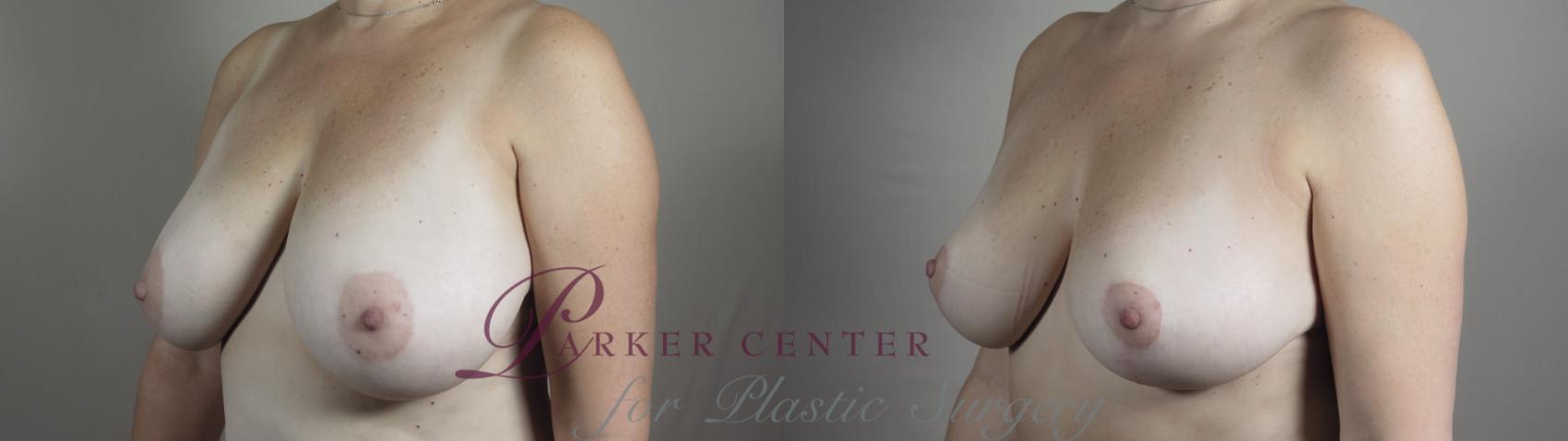 Breast Lift Case 968 Before & After 3/4 view right  | Paramus, NJ | Parker Center for Plastic Surgery