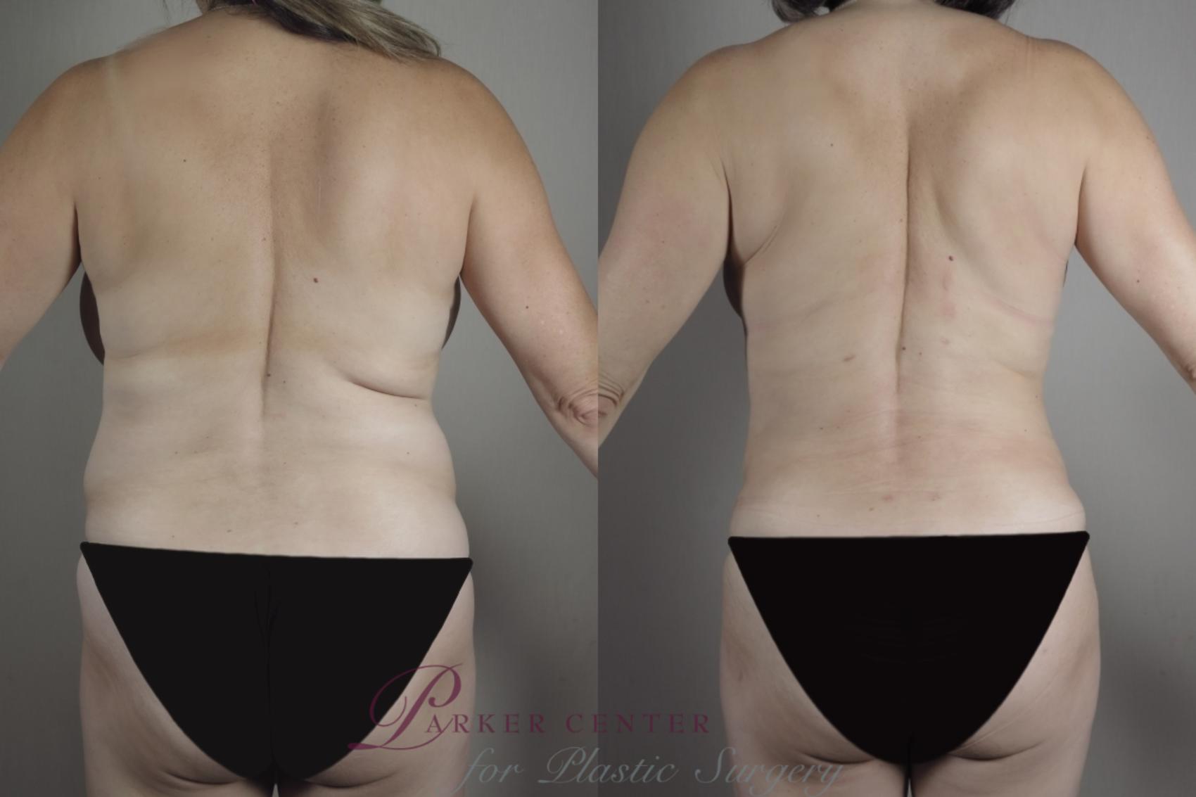 Breast Lift Case 968 Before & After Back | Paramus, NJ | Parker Center for Plastic Surgery