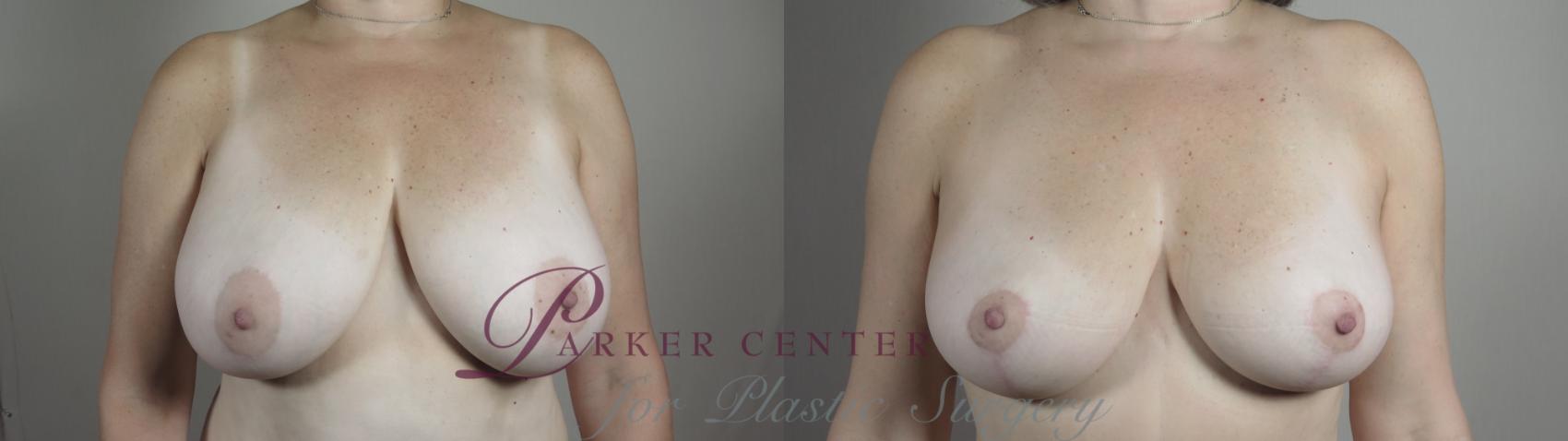 Breast Lift Case 968 Before & After Front | Paramus, NJ | Parker Center for Plastic Surgery