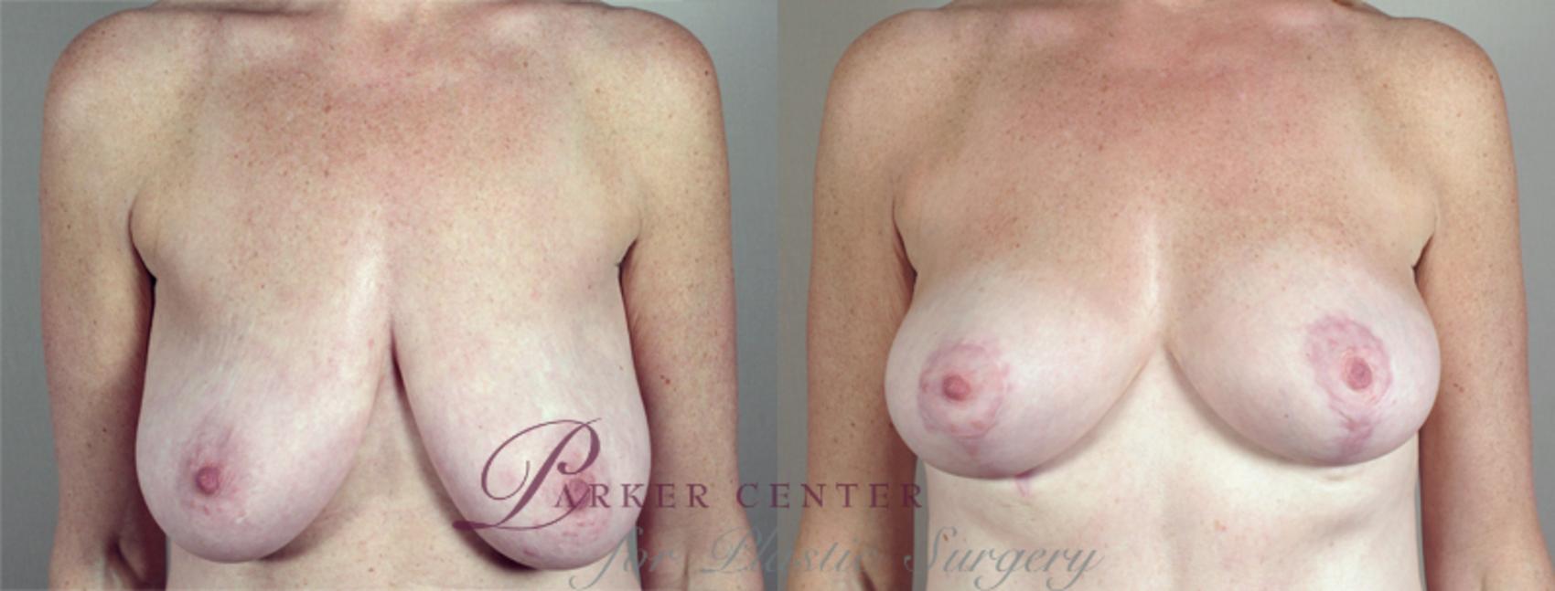 Breast Lift with Auto Aug Case 518 Before & After View #1 | Paramus, NJ | Parker Center for Plastic Surgery
