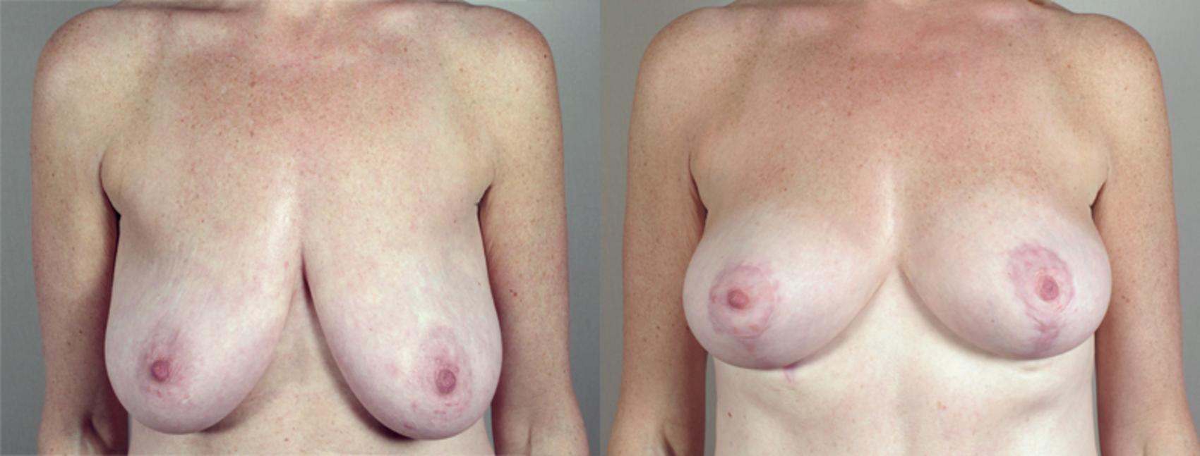 Breast Lift with Auto Aug Case 518 Before & After View #1 | Paramus, NJ | Parker Center for Plastic Surgery