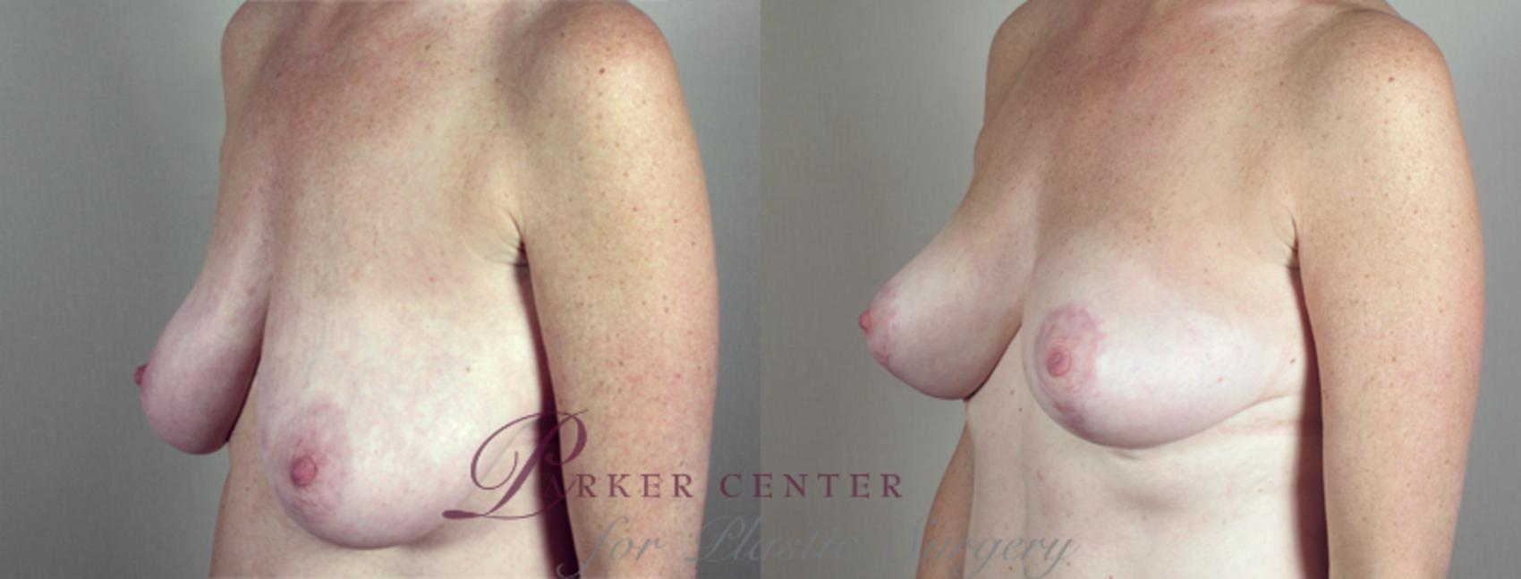 Breast Lift with Auto Aug Case 518 Before & After View #2 | Paramus, NJ | Parker Center for Plastic Surgery