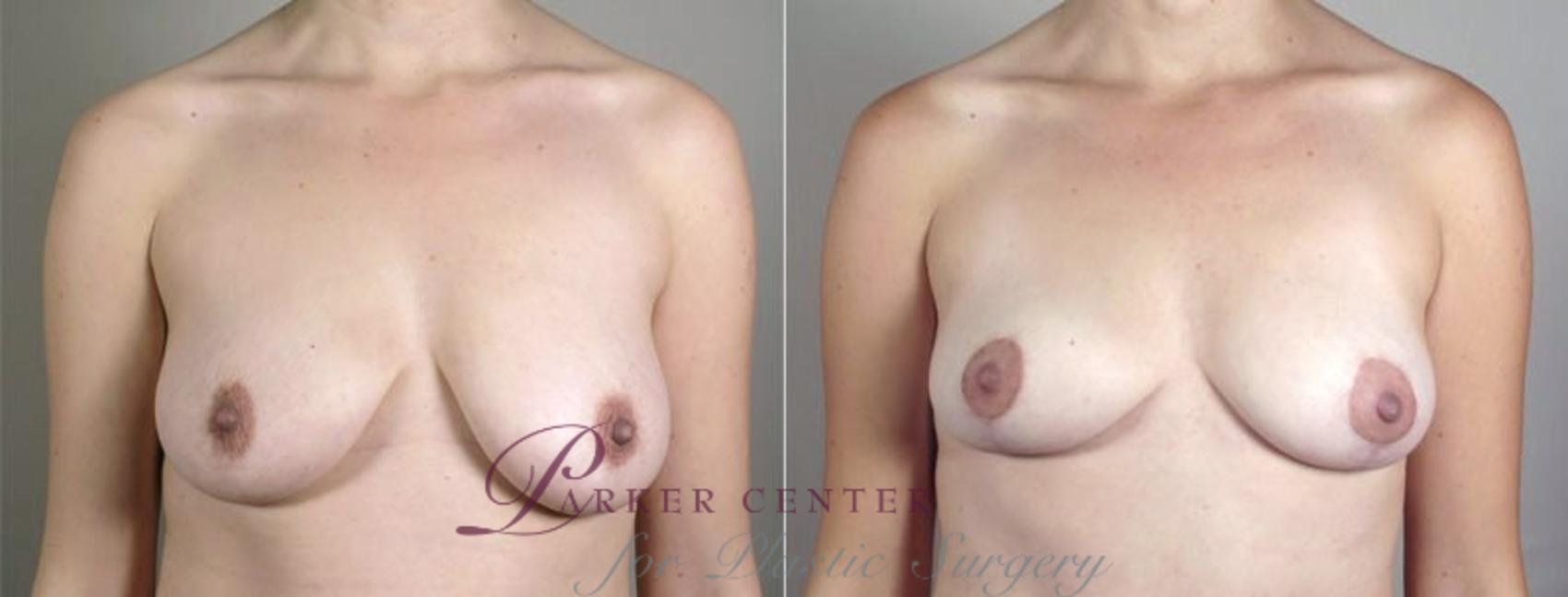 Breast Lift with Auto Aug Case 519 Before & After View #1 | Paramus, NJ | Parker Center for Plastic Surgery