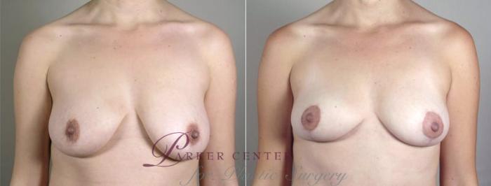 Breast Lift with Auto Aug Case 519 Before & After View #1 | Paramus, NJ | Parker Center for Plastic Surgery