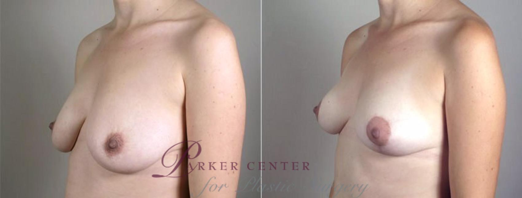 Breast Lift with Auto Aug Case 519 Before & After View #2 | Paramus, NJ | Parker Center for Plastic Surgery