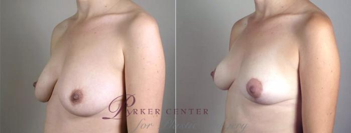 Breast Lift with Auto Aug Case 519 Before & After View #2 | Paramus, NJ | Parker Center for Plastic Surgery
