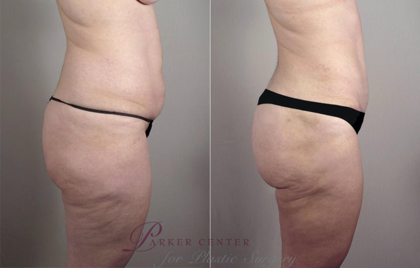 Mommy Makeover Case 519 Before & After View #4 | Paramus, NJ | Parker Center for Plastic Surgery