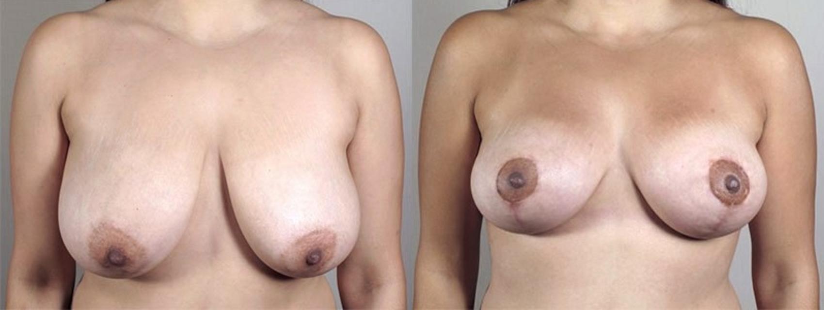 Breast Lift with Auto Aug Case 520 Before & After View #1 | Paramus, NJ | Parker Center for Plastic Surgery