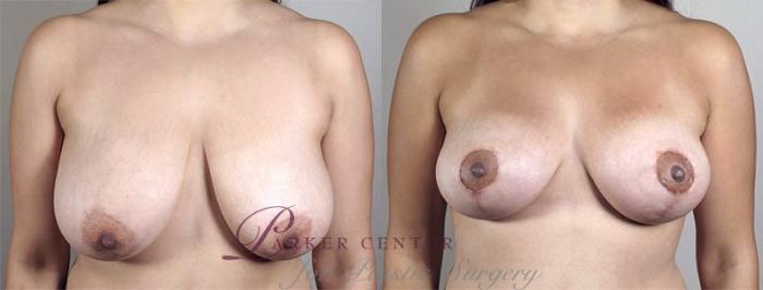 Breast Lift with Auto Aug Case 520 Before & After View #1 | Paramus, NJ | Parker Center for Plastic Surgery
