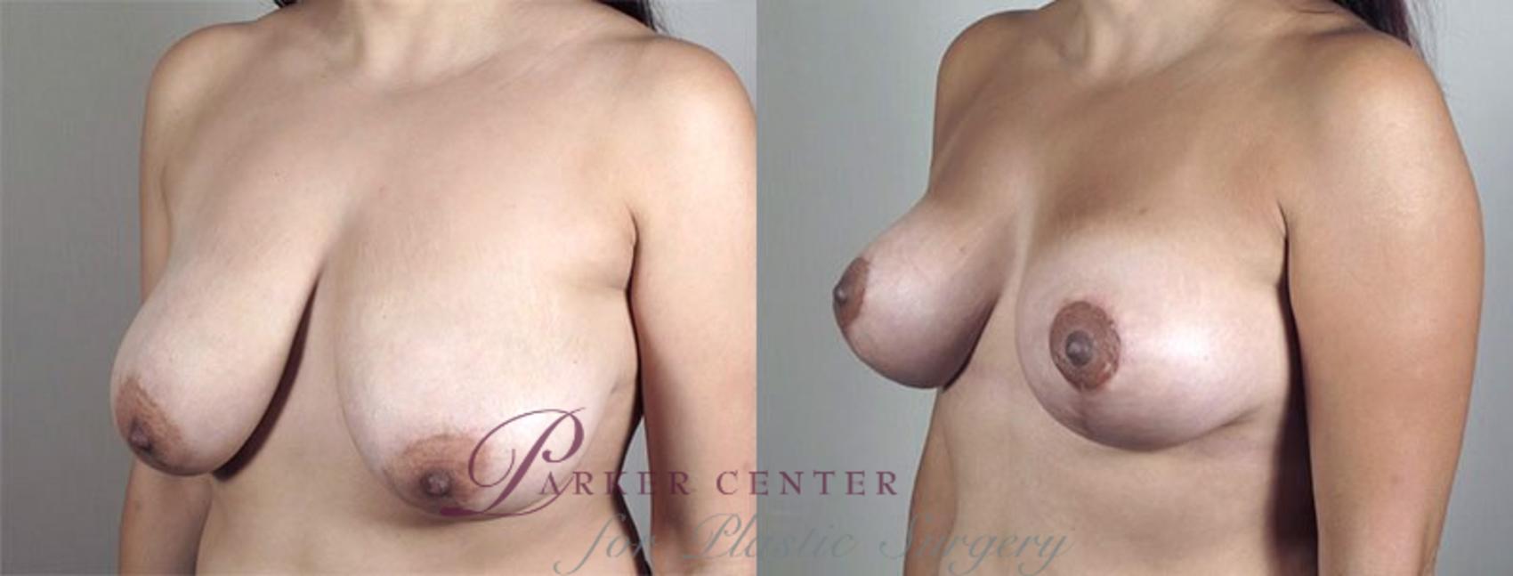 Breast Lift with Auto Aug Case 520 Before & After View #2 | Paramus, NJ | Parker Center for Plastic Surgery