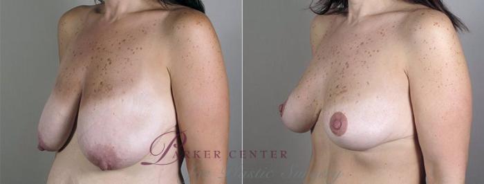 Mommy Makeover Case 521 Before & After View #2 | Paramus, NJ | Parker Center for Plastic Surgery