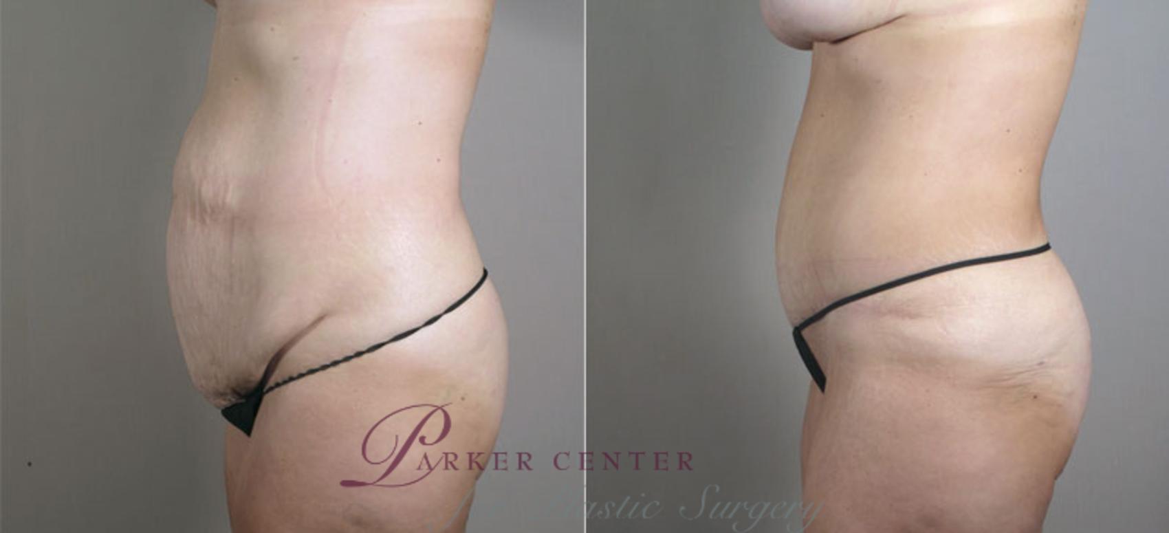 Mommy Makeover Case 521 Before & After View #4 | Paramus, NJ | Parker Center for Plastic Surgery