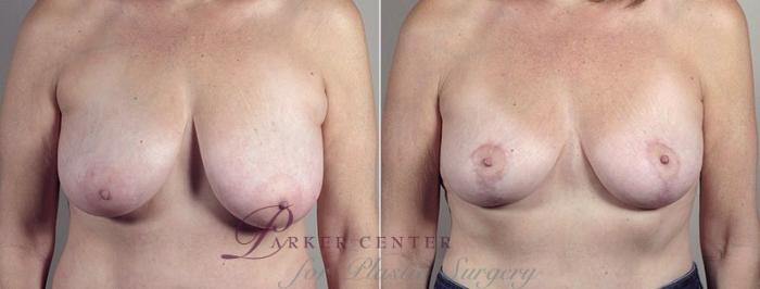 Breast Lift with Auto Aug Case 522 Before & After View #1 | Paramus, NJ | Parker Center for Plastic Surgery