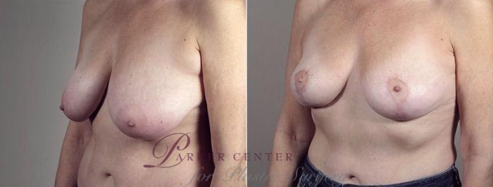 Breast Lift with Auto Aug Case 522 Before & After View #2 | Paramus, NJ | Parker Center for Plastic Surgery