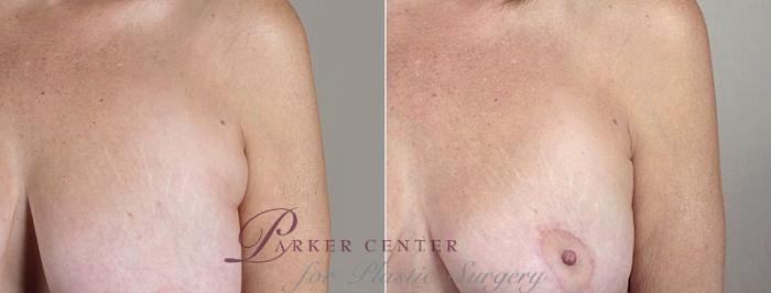 Breast Lift with Auto Aug Case 522 Before & After View #3 | Paramus, NJ | Parker Center for Plastic Surgery