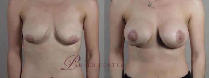 Breast Lift with Implants Case 1283 Before & After Front | Paramus, NJ | Parker Center for Plastic Surgery