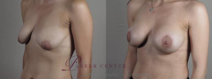 Breast Lift with Implants Case 1283 Before & After Left Oblique | Paramus, NJ | Parker Center for Plastic Surgery