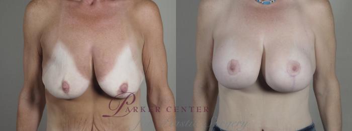 Breast Lift with Implants Case 1297 Before & After Front | Paramus, NJ | Parker Center for Plastic Surgery