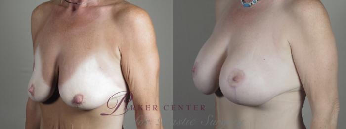 Breast Lift with Implants Case 1297 Before & After Left Oblique | Paramus, NJ | Parker Center for Plastic Surgery
