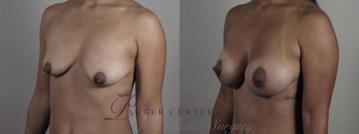Breast Lift with Implants Case 1299 Before & After Left Oblique | Paramus, NJ | Parker Center for Plastic Surgery