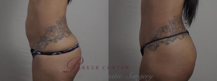 Breast Lift with Implants Case 1299 Before & After Left Side | Paramus, NJ | Parker Center for Plastic Surgery