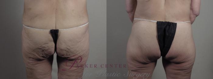 Breast Lift Case 1301 Before & After Back | Paramus, NJ | Parker Center for Plastic Surgery