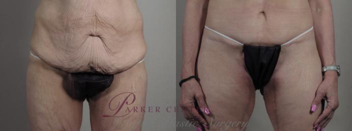 Breast Augmentation Case 1301 Before & After front  | Paramus, NJ | Parker Center for Plastic Surgery