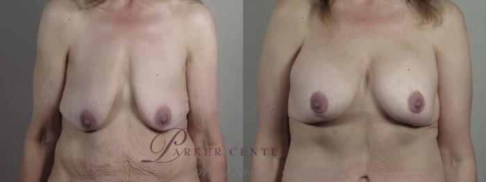 Breast Lift with Implants Case 1301 Before & After Front | Paramus, NJ | Parker Center for Plastic Surgery