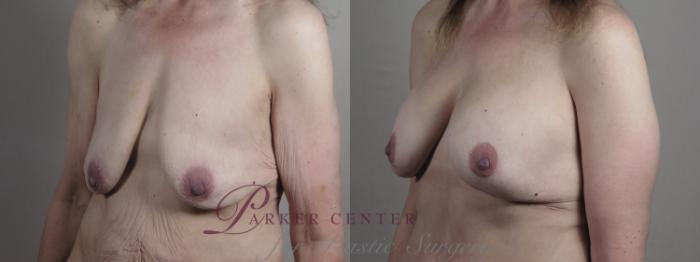 Breast Lift with Implants Case 1301 Before & After Left Oblique | Paramus, NJ | Parker Center for Plastic Surgery
