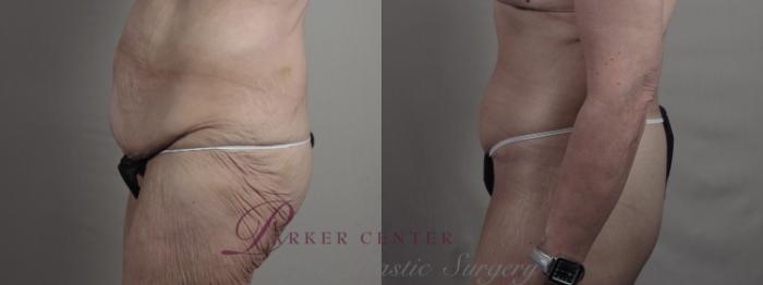 Breast Lift with Implants Case 1301 Before & After Left Side | Paramus, NJ | Parker Center for Plastic Surgery