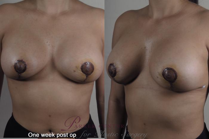 Breast Lift with Implants Case 1358 Before & After 1 week  | Paramus, New Jersey | Parker Center for Plastic Surgery
